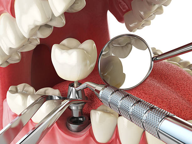 Best Emergency Tooth Extraction in Rden City, GA