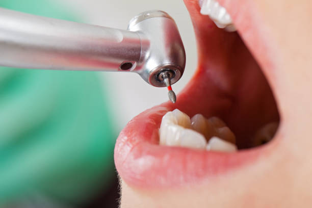 Best Emergency Treatment for Dental Infections or Abscesses in Rden City, GA